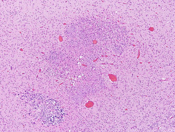 18D4 Hypoxia-Ischemia, neonatal, intrauterine (Case 18) H&E N12 4