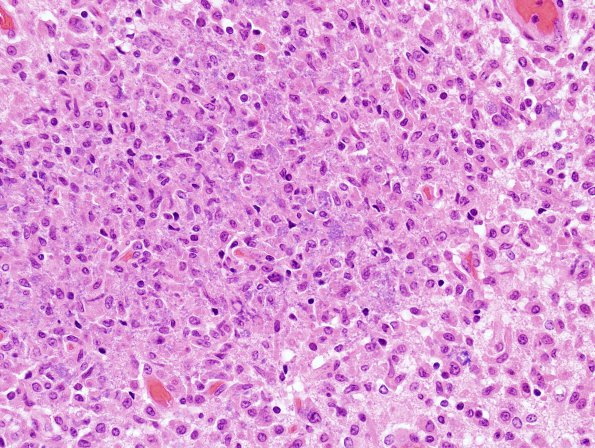 18D5 Hypoxia-Ischemia, neonatal, intrauterine (Case 18) H&E N12 2