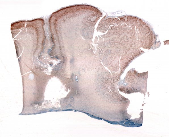 18E2 Hypoxia-Ischemia, neonatal, intrauterine (Case 18) NeuN N13 WM