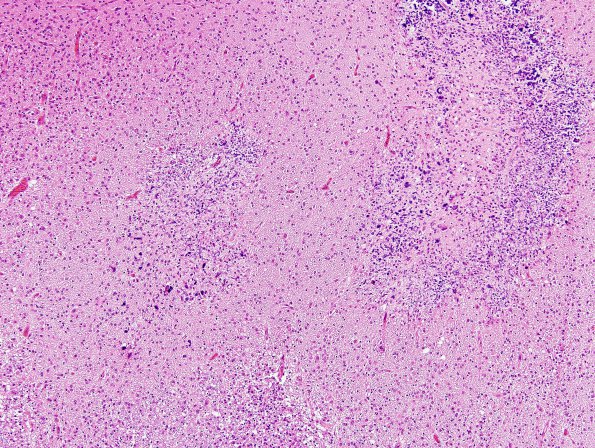 18E3 Hypoxia-Ischemia, neonatal, intrauterine (Case 18) H&E N13 2