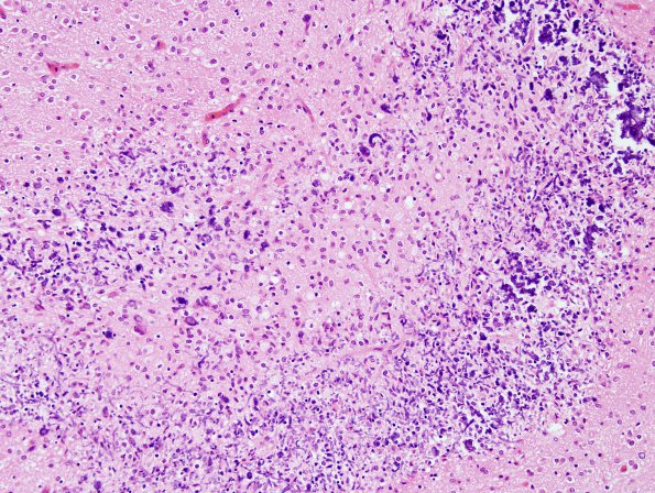 18E4 Hypoxia-Ischemia, neonatal, intrauterine (Case 18) H&E N13 1