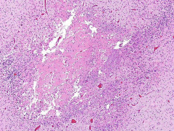 18F3 Hypoxia-Ischemia, neonatal, intrauterine (Case 18) H&E N14 4