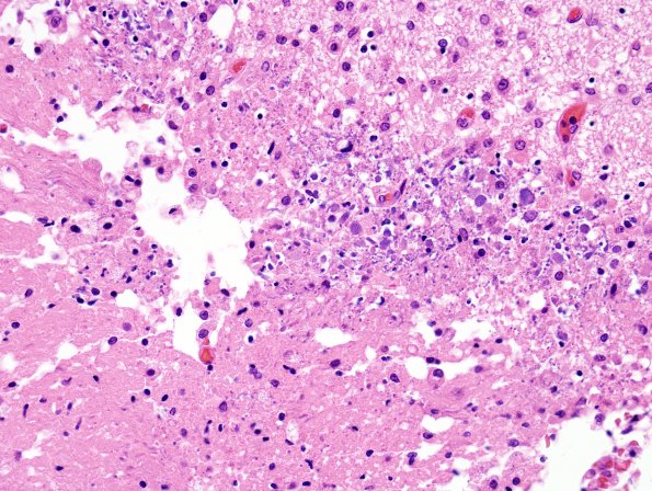 18F4 Hypoxia-Ischemia, neonatal, intrauterine (Case 18) H&E N14 3