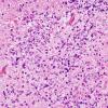 18F5 Hypoxia-Ischemia, neonatal, intrauterine (Case 18) H&E N14 5