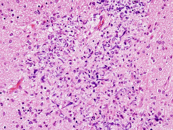 18F5 Hypoxia-Ischemia, neonatal, intrauterine (Case 18) H&E N14 5