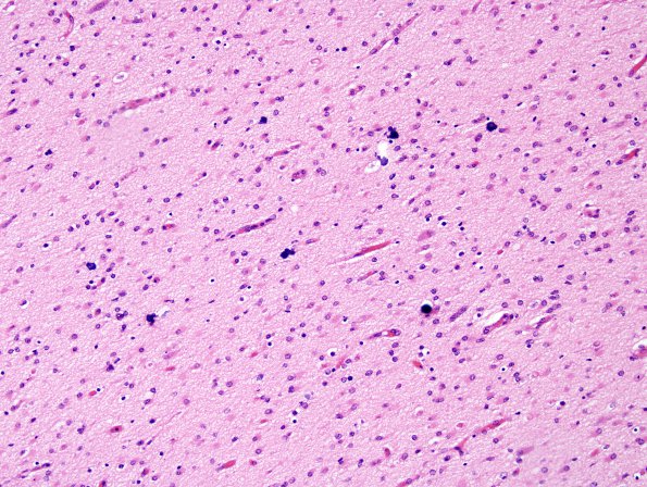 18F6 Hypoxia-Ischemia, neonatal, intrauterine (Case 18) H&E N14 1