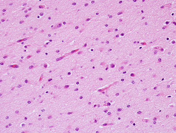 18F7 Hypoxia-Ischemia, neonatal, intrauterine (Case 18) H&E N14 2