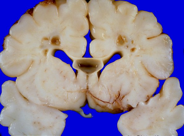 1A1 Infarct, Neonatal, Periventricular (Case 1) 2