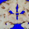 1A2 Infarct, Neonatal, Periventricular (Case 1) 3