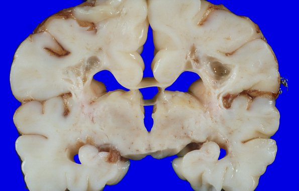 1A2 Infarct, Neonatal, Periventricular (Case 1) 3