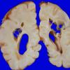 1A3 Infarct, Neonatal, Periventricular (Case 1) 4