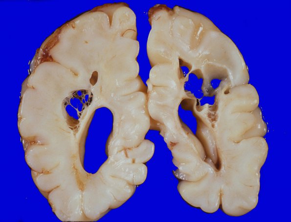 1A3 Infarct, Neonatal, Periventricular (Case 1) 4