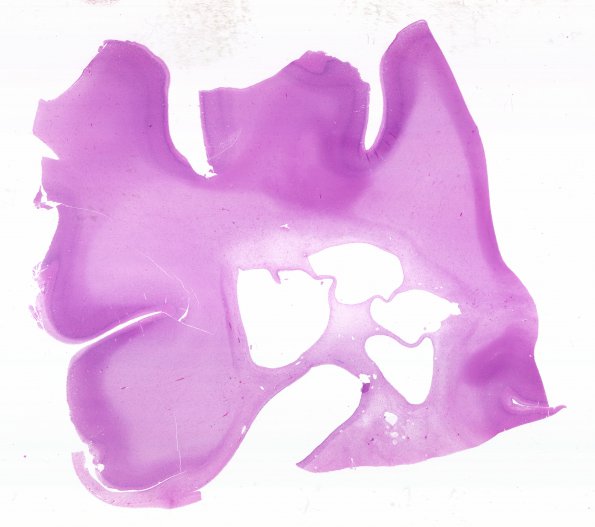 1B1 Infarct, Neonatal, Periventricular (Case 1) N1 WM