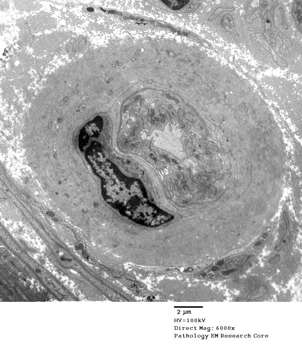 1B1 Vasculopathy (Case 1) EM026A - Copy