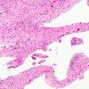 1B2 Infarct, Neonatal, Periventricular (Case 1) N3 H&E 2