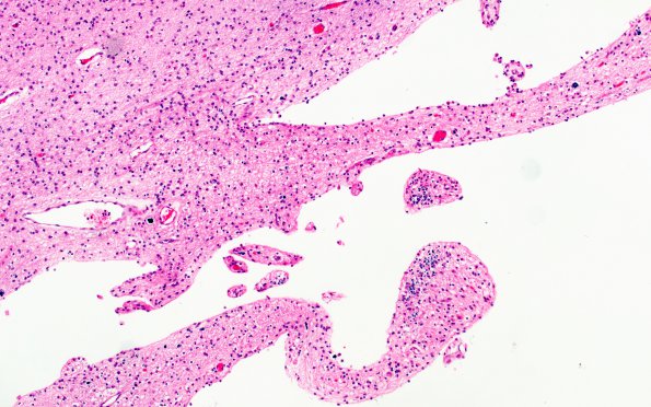 1B2 Infarct, Neonatal, Periventricular (Case 1) N3 H&E 2