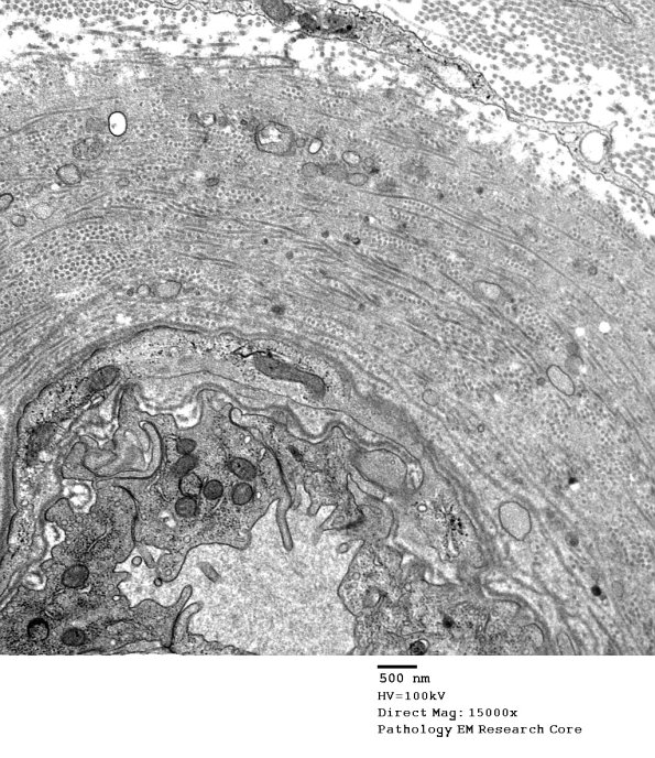 1B2 Vasculopathy (Case 1) EM018 - Copy