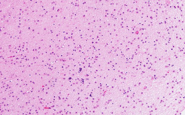 1B3 Infarct, Neonatal, Periventricular (Case 1) N1 H&E 1