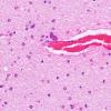 1B4 Infarct, Neonatal, Periventricular (Case 1) N1 H&E 2