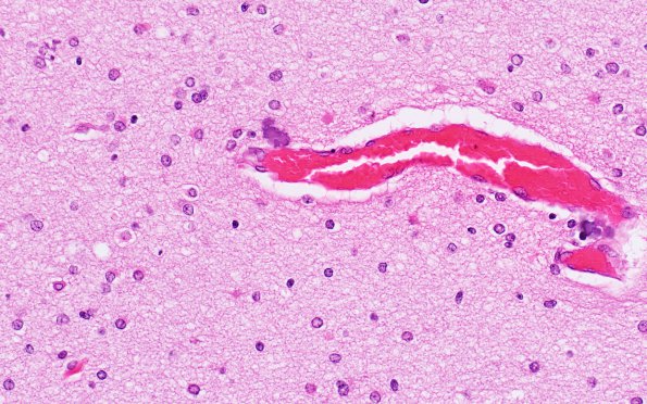 1B4 Infarct, Neonatal, Periventricular (Case 1) N1 H&E 2