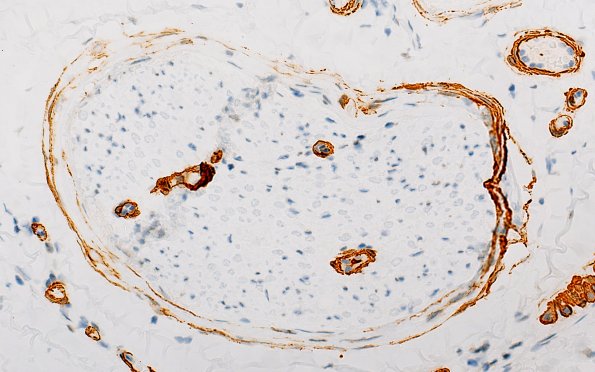 2B Vasculopathy (Case 2) SMA 40X 3