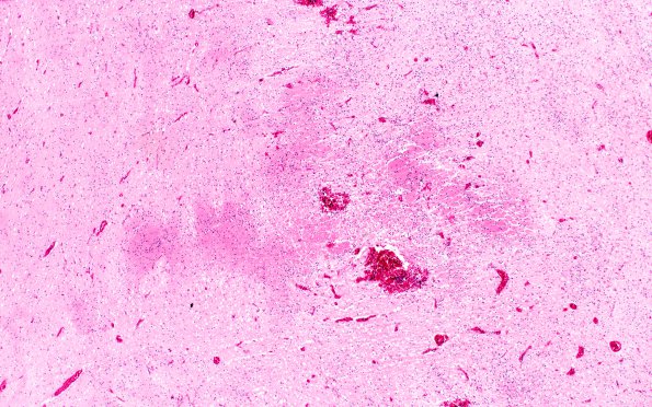 2B2 Hypoxia Ischemia, PVinfarcts (Case 2) H&E 2X 3