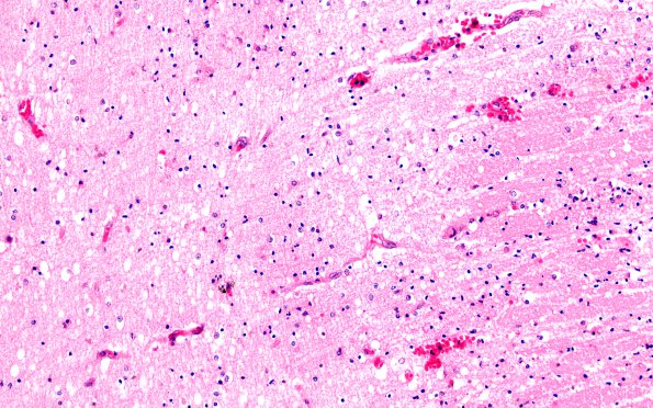 2B3 Hypoxia Ischemia, PVinfarcts (Case 2) H&E 20X 3