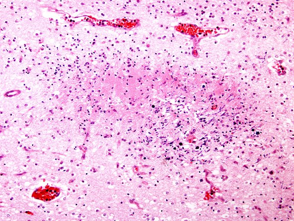 2B4 Hypoxia Ischemia, PVinfarcts (Case 2) H&E A1 - Copy