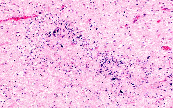 2B5 Hypoxia Ischemia, PVinfarcts (Case 2) H&E 20X