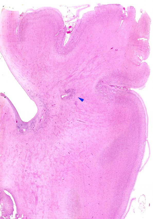 2C1 Hypoxia Ischemia, PVinfarcts (Case 2) H&E WM 2 copy