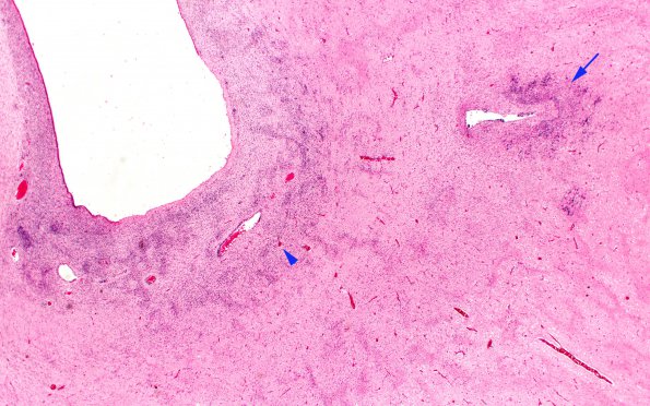 2C2 Hypoxia Ischemia, PVinfarcts (Case 2) H&E 20X 3 copy