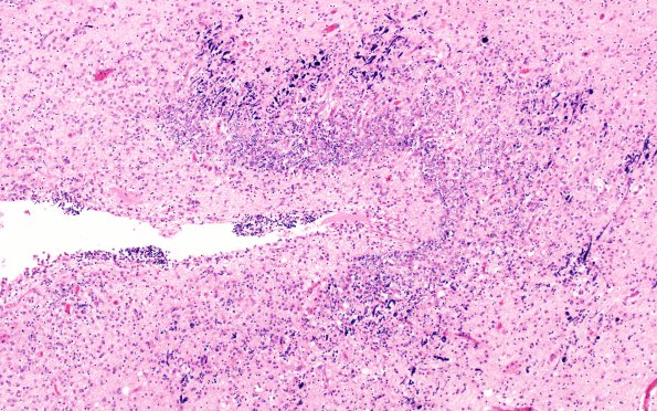 2C3 Hypoxia Ischemia, PVinfarcts (Case 2) H&E 20X 2