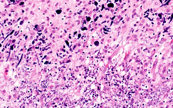 2C4 Hypoxia Ischemia, PVinfarcts (Case 2) H&E 40X 2