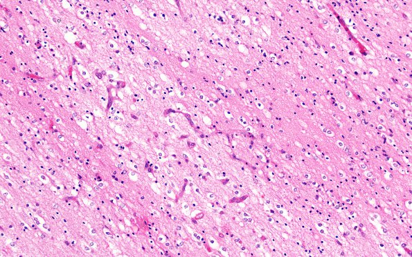 2C5 Hypoxia Ischemia, PVinfarcts (Case 2) H&E 20X Endo prolif