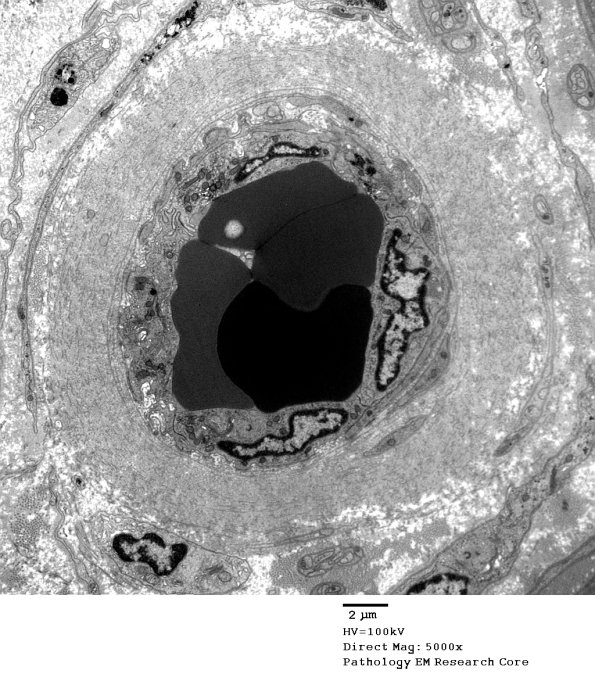 2D1A Vasculopathy (Case 2) EM 008 - Copy