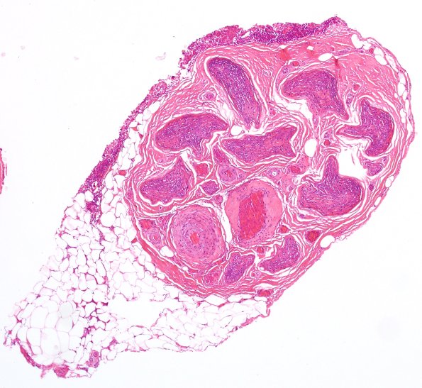 3A1 Vasculopathy (Case 3) H&E 5