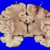 3A2 Hypoxia-Ischemia Neonatal (Case 3) 5 copy