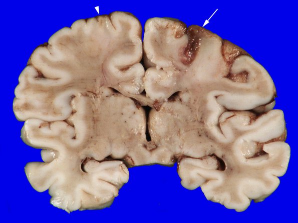 3A2 Hypoxia-Ischemia Neonatal (Case 3) 5 copy