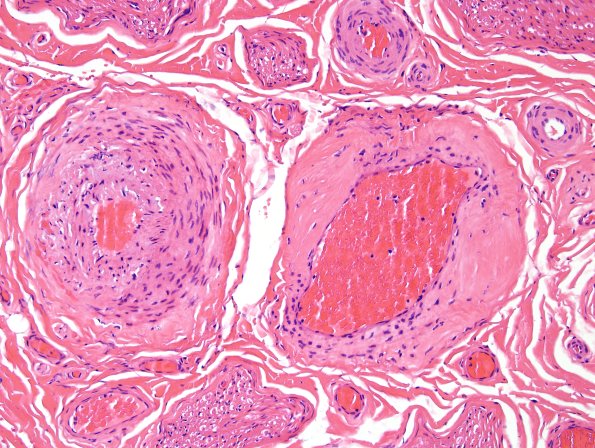 3A2 Vasculopathy (Case 3) H&E 3