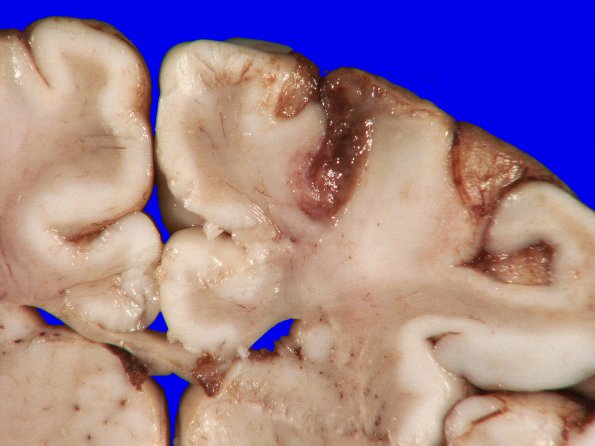 3A3 Hypoxia-Ischemia Neonatal (Case 3) 6