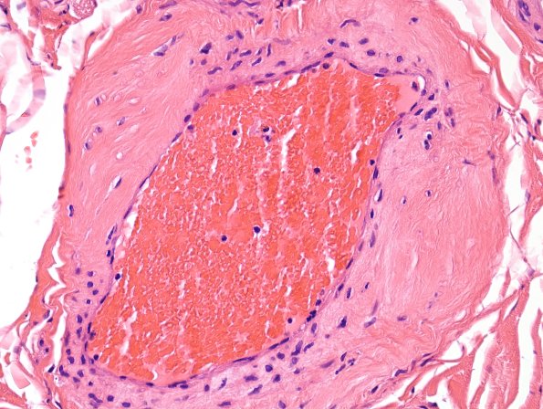 3A3 Vasculopathy (Case 3) H&E 2