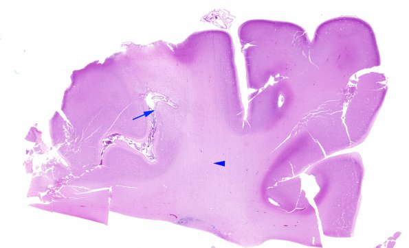 3B1 Hypoxia-Ischemia Neonatal (Case 3) H&E WM 3