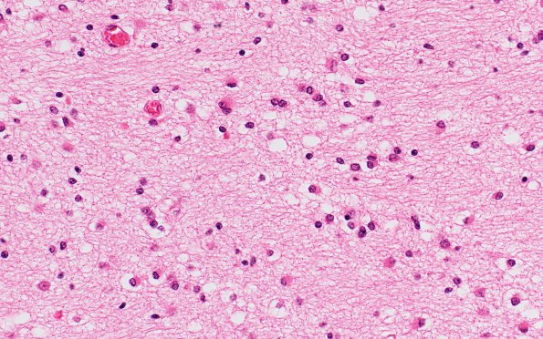 3B2 Hypoxia-Ischemia Neonatal (Case 3) H&E 3A