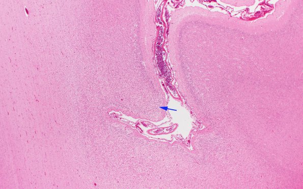 3B3 Hypoxia-Ischemia Neonatal (Case 3) N12 H&E 2X copy