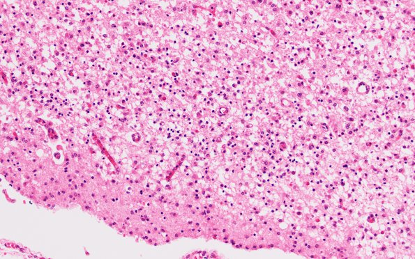 3B4 Hypoxia-Ischemia Neonatal (Case 3) N12 H&E 20X