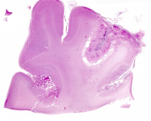 3C1 Hypoxia-Ischemia Neonatal (Case 3) H&E WM 2