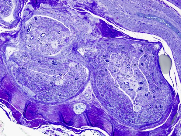 3C1 Vasculopathy (Case 3) Plastic 2