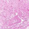 3C2 Hypoxia-Ischemia Neonatal (Case 3) H&E 5