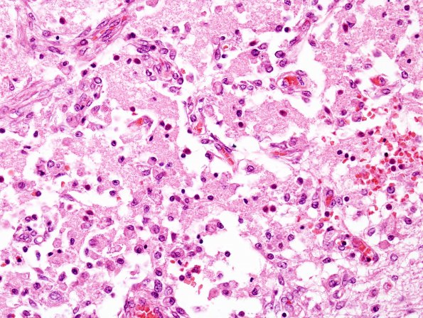 3C3 Hypoxia-Ischemia Neonatal (Case 3) H&E 1