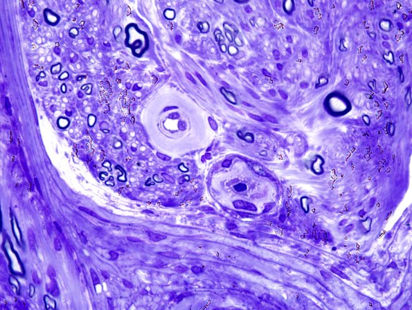 3C3 Vasculopathy (Case 3) Plastic 3